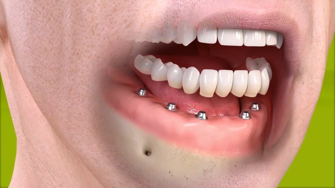 Standbild: Erklärvideo festsitzende Restauration mit 4 bis 6 Implantaten
