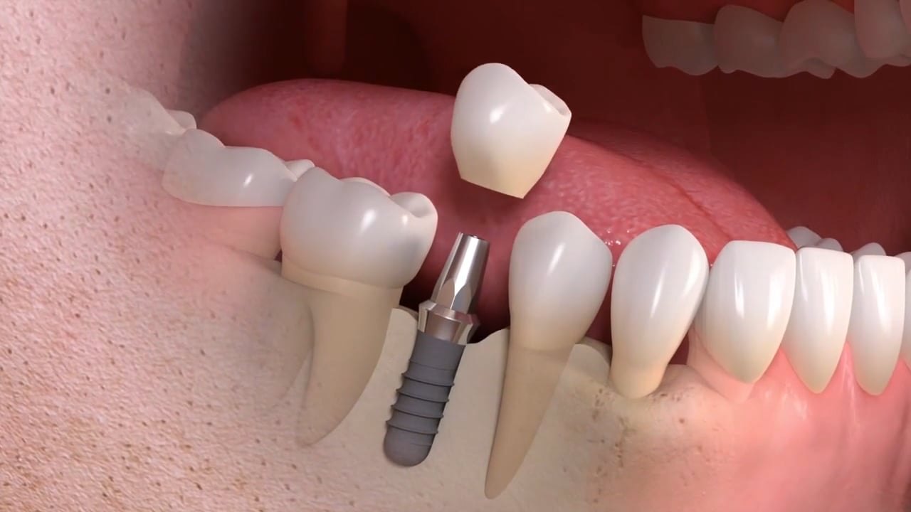 Standbild: Erklärvideo implantatgetragener Einzelzahnersatz