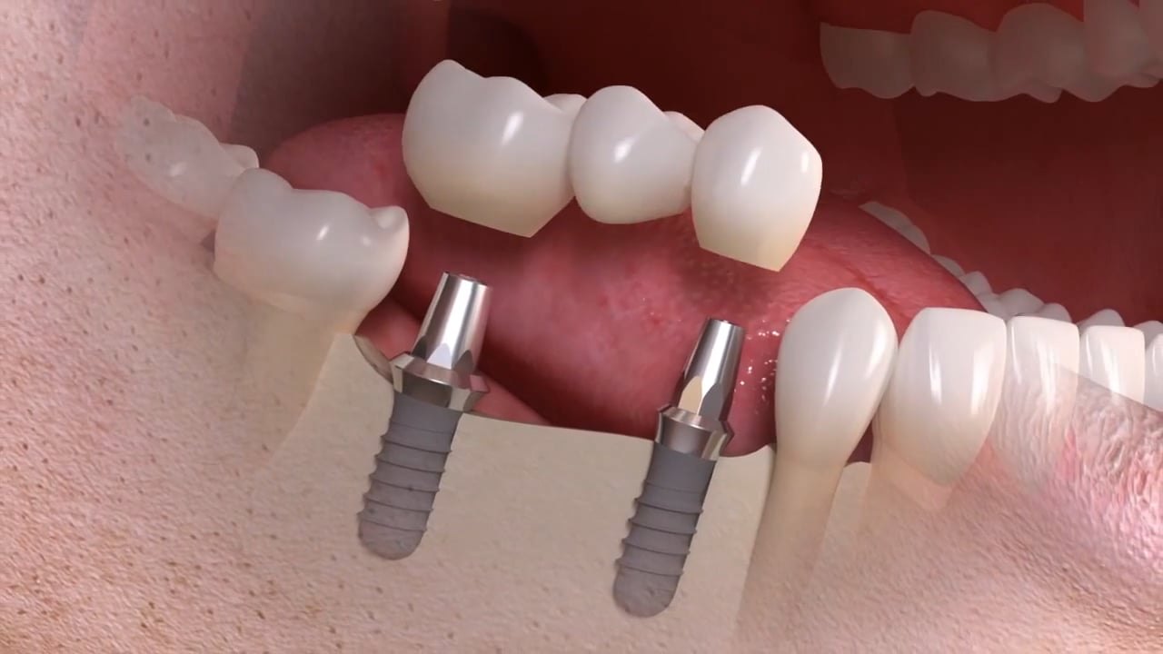 Standbild: Erklärvideo implantatgetragener Mehrzahnersatz